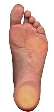 Des Moines Podiatrist | Des Moines Flatfoot (Fallen Arches) | IA | Advanced Foot & Ankle Clinic |